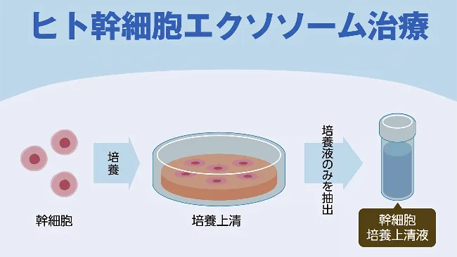 ヒト幹細胞エクソソーム治療